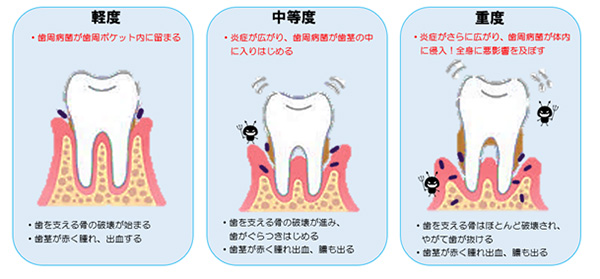 あなたの歯周病菌どこまで侵入してますか？