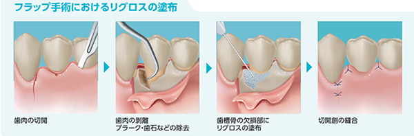 歯周組織再生療法