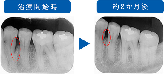 当院でのリグロス治療の様子