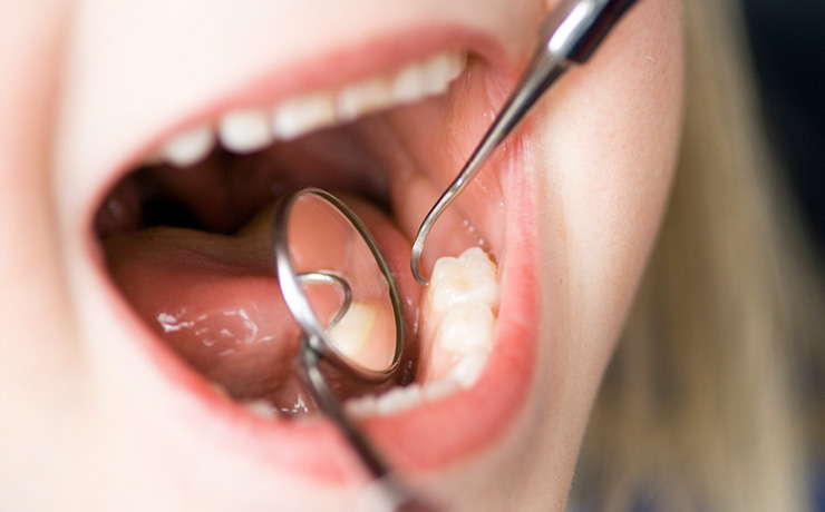 むし歯や歯周病を防ぐ「予防歯科」